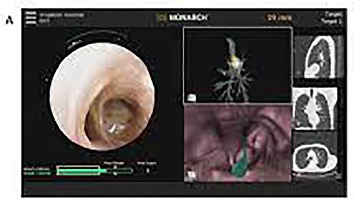 CD Hospital Successfully Manages Lung Cancer Patient Via Bronchoscopic Intervention