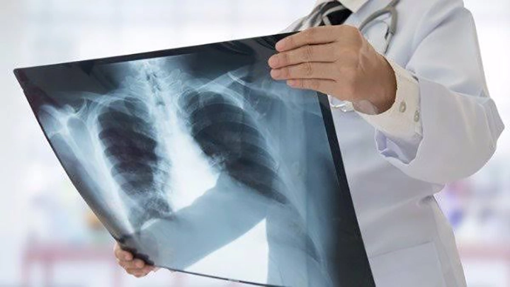 80% of Lung Cancer Cases Attributed to Smoking: Doctors